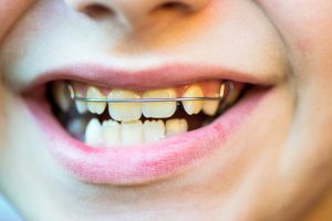 Attelle orthodontique pour dent traumatisée 